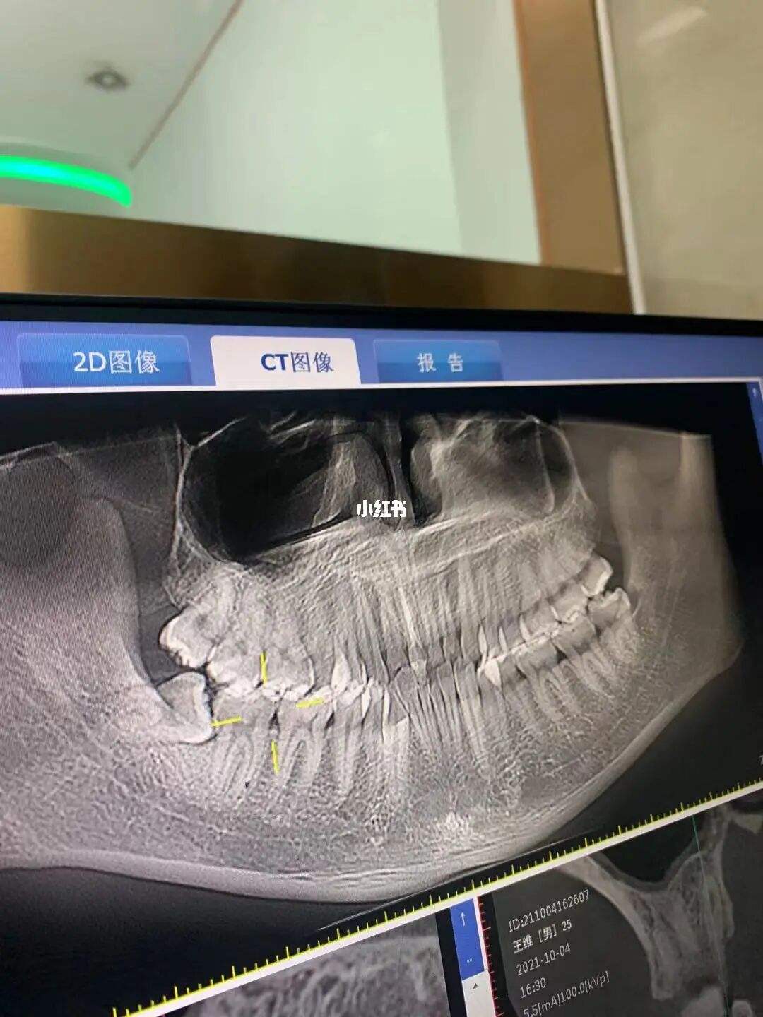 拔一颗牙要多少钱(牙科拔一颗牙要多少钱) 拔一颗牙要多少钱(牙科拔一颗牙要多少钱)