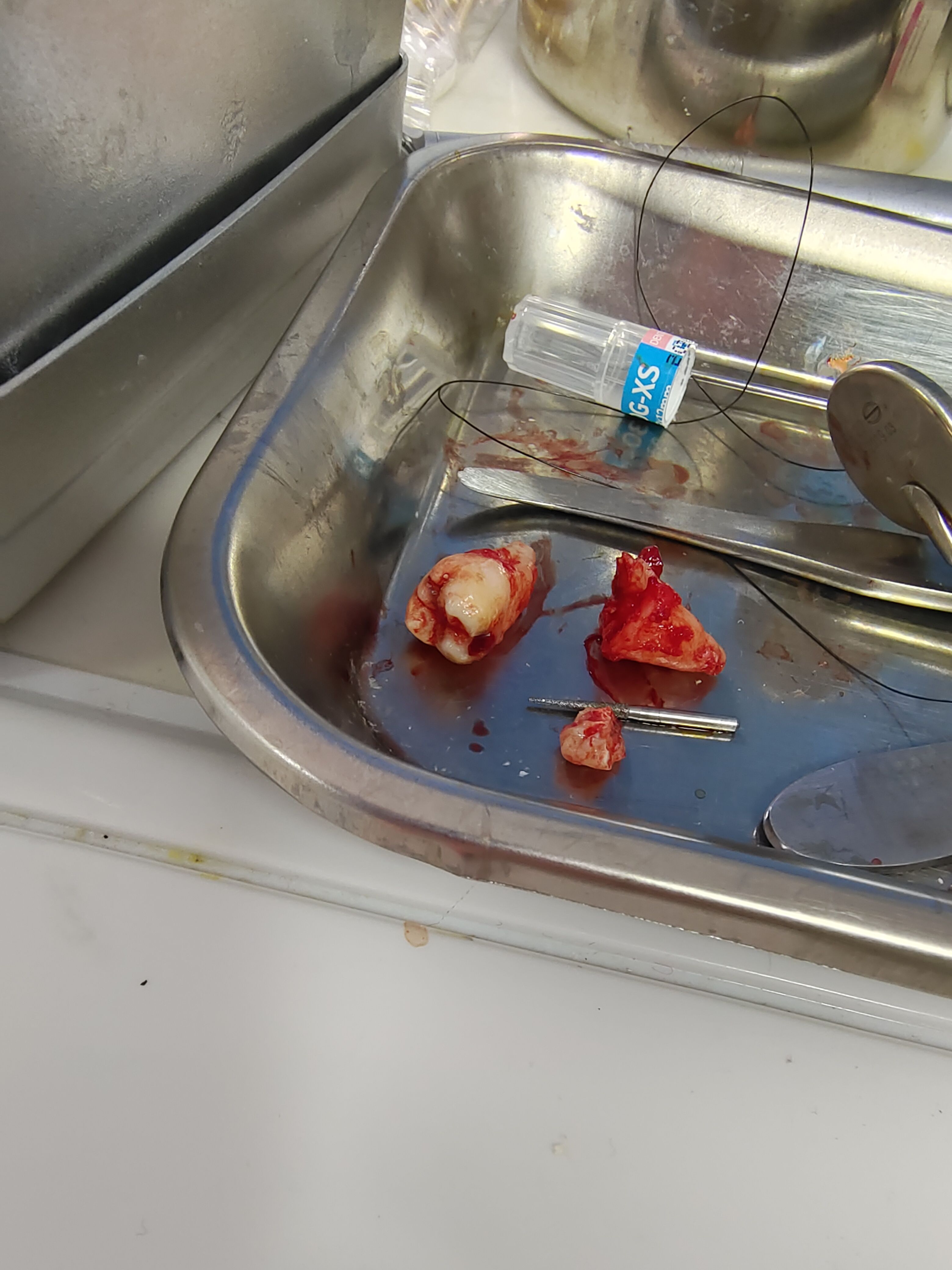 拔一颗牙要多少钱(牙科拔一颗牙要多少钱) 拔一颗牙要多少钱(牙科拔一颗牙要多少钱)