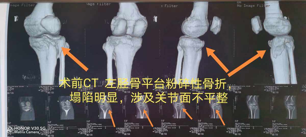 三维重建ct(三维重建ct多久出结果) 三维重建ct(三维重建ct多久出结果)
