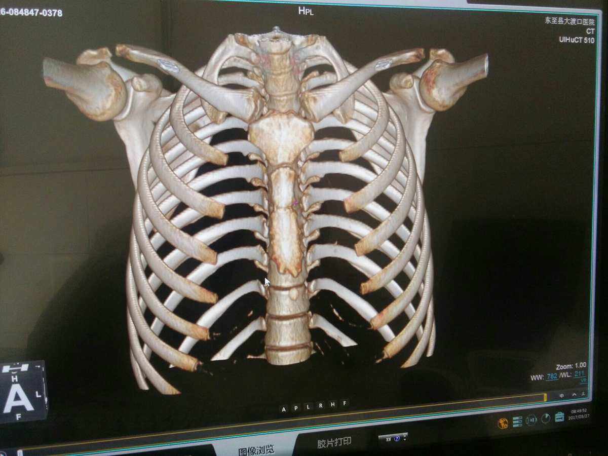 三维重建ct(三维重建ct多久出结果) 三维重建ct(三维重建ct多久出结果)